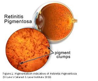 4) Diagnostic Terms (3) Diseases of inner coat( 내막성질환 ) retinitis [rètənáitis] 망막염 retinitis