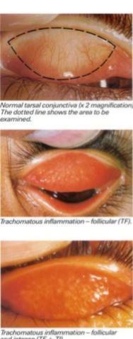 4) Diagnostic Terms (4) 눈부속기관의질환및기타 trachoma 트라코마클라미디아트라코마티스