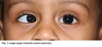 4) Diagnostic Terms (4) 눈부속기관의질환및기타 strabismus [strə