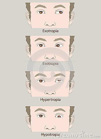 이조절이안되어한쪽혹은두쪽눈의시선이편위 esotropia 내사시안쪽으로편위된경우이다.