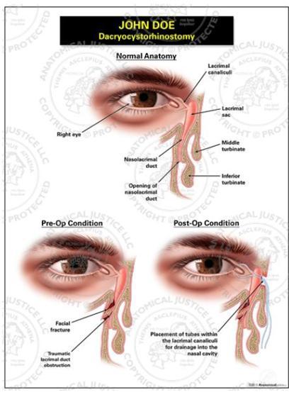 5) Operative Terms dacryoadenectomy 눈물샘절제술 dacryocystostomy 눈물샘주머니창냄술 눈물샘주머니에새로운통로를만들어주는것