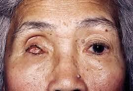 5) Operative Terms enucleation [injù:kliéiʃən] of bulb [bʌlb] 눈적출 ( 술 ) 안구내용제거술 ( 내장적출술, 내용물적출술 ) 공막과각막을남기고안구의내용물을제거하는것 glaucoma operation 녹내장수술 cyclodialysis 섬모체해리 ( 술 ) 안구내압력을낮추기위해앞안방 (anterior