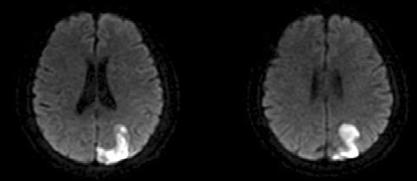 Fig. 2. Brain MR images of the patient. Axial diffusion-weighted images show the left parieto-occipital infarction involving the superior parietal lobule. Fig. 3. Video-oculography.