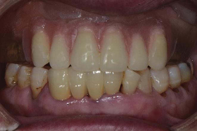 of clear acrylic resin, (D) Maxillary occlusal view 2 weeks after maxillectomy, (E) Relined