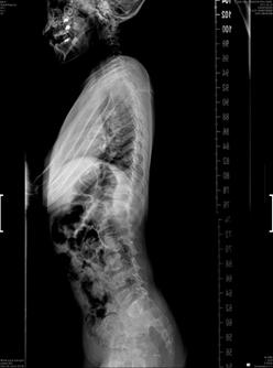 (B) Lateral thoracolumbar spine radiograph demonstrating lordosis. Figure 3. Sequencing of exon 43 in COL2A1 revealed a novel c.3055c > T (p.