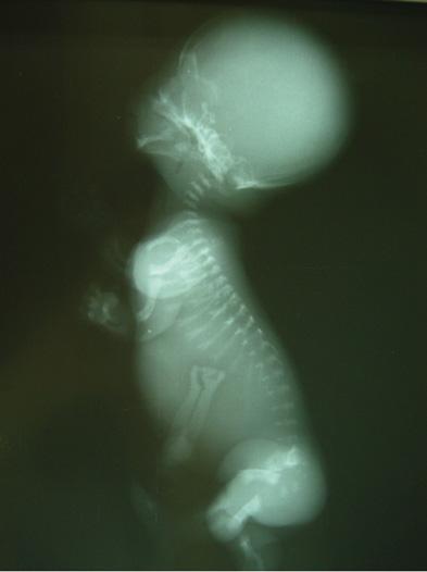 굴지골격이형성증 (Camptomelic dysplasia) 은하지의장골이휘어있으면서소지증 (micromelia) 을보여어깨뼈의형성부전증등을보여진단할수있었다.