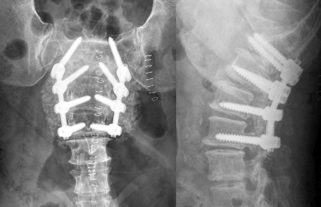 (A) Initial anteroposterior and lateral radiographs show degenerative lumbar disease with L4 5 anterolisthesis.