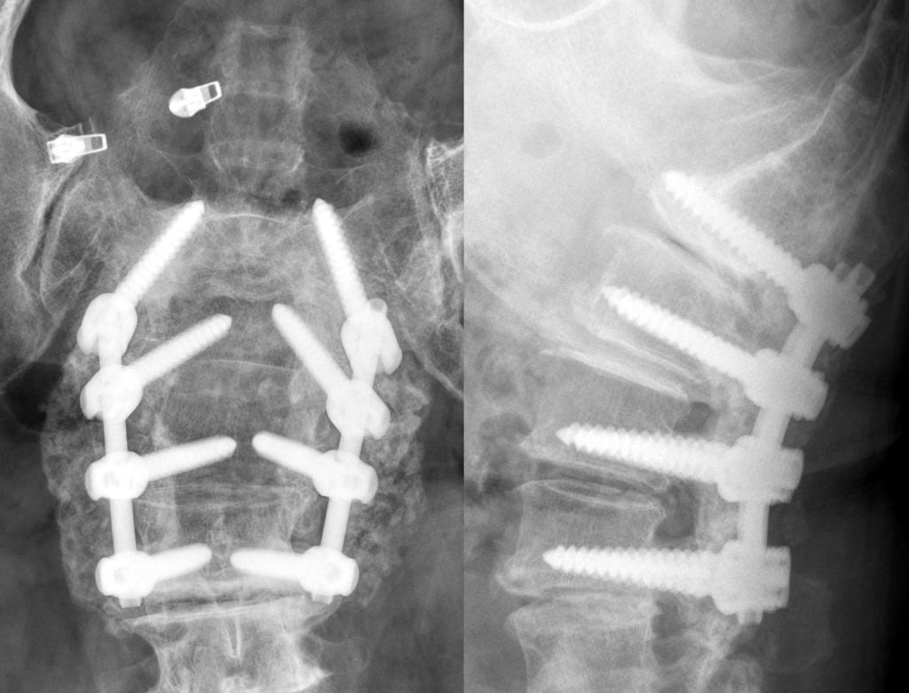 (C) At 30 weeks after the operation, anteroposterior and lateral radiographs show that the fusion mass was formed bilaterally, which was defined as Lenke s scale A.