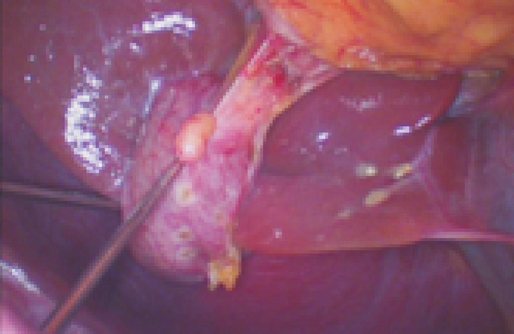 107 담낭절제술 (single port laparoscopic cholecystectomy, SLC) 의경우 1997 년에 Navarra et al. 4 의해최초로시행되었으며, 이후여러연구를통해임상적유용성과안정성, 미용적결과의향상이보고되고있다.