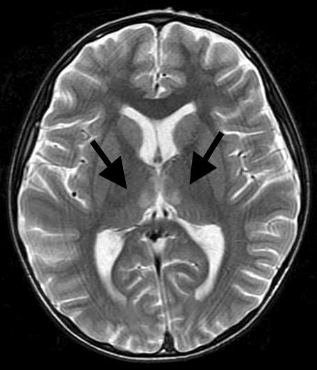 (B) Brain CT shows multifocal intracerebral hemorrhage with perilesional edema at both caudate nuclei and left corpus callosum and intraventricular hemorrhage.