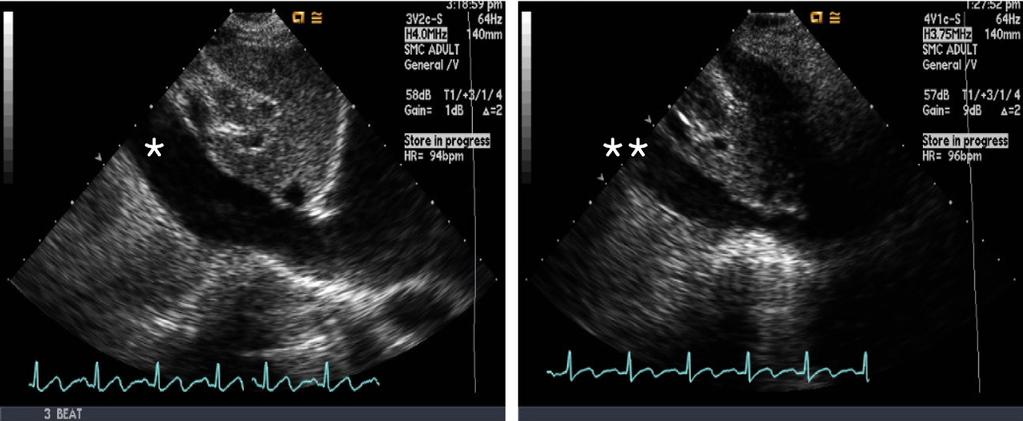 Spot 1 indicates the V fistula between the right common iliac artery and the left common iliac vein, and spot 2 denotes the V fistula between the right