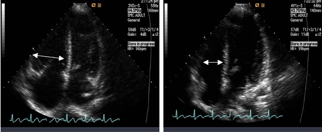 () 2D Echocardiography showed improvement of the inferior vena cava (IVC) dilatation from 26 mm to 17 mm.