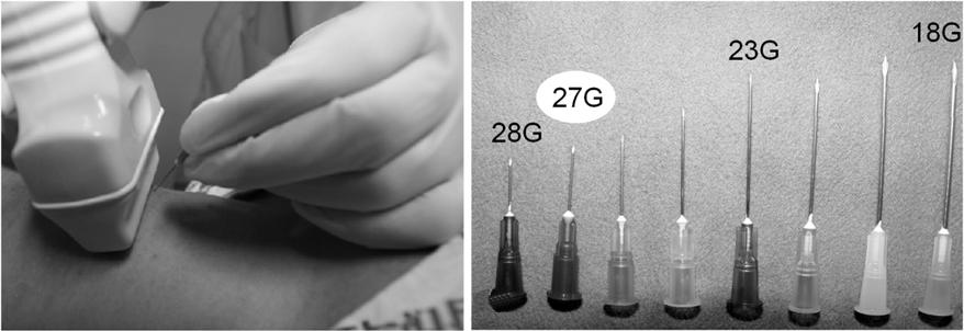 - 강호철. 갑상선암의초음파, 세포및유전자진단 - A Figure 3. (A) US-guided FNA without suction (capillary technique). (B) Needles used in FNA. A 27 G needle is useful for most nodules and less painful.