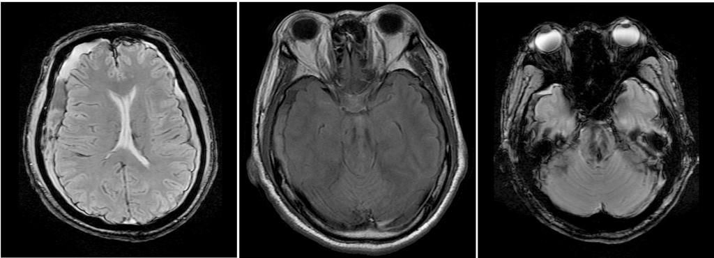 Jeong-Ho Hong Intracranial hypertension and herniation syndrome A B C Figure 3. Central herniation.