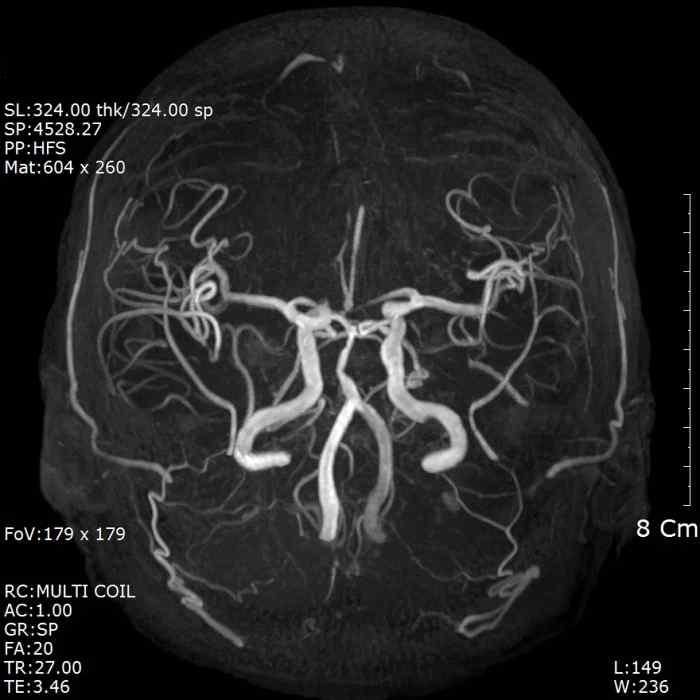 2, Fig. 3) (1) multiple acute infarctions in left ACA territory. (2) multiple subacute to chronic cerebral infarction in right ACA territory.