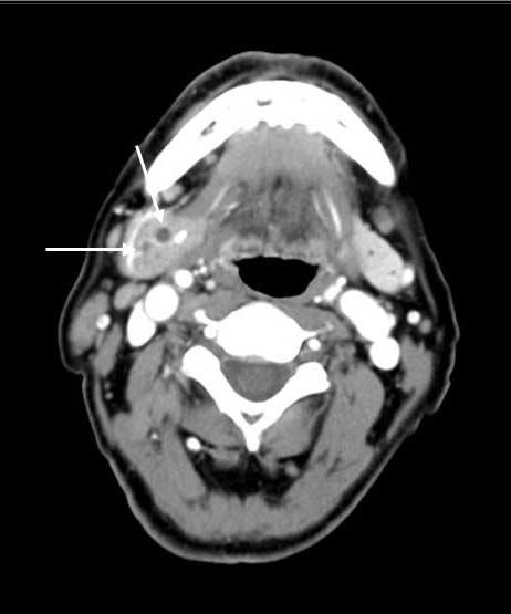 Acute parotitis with tonsillitis in a 17-year-old girl with palpable mass in left infraauricular neck.