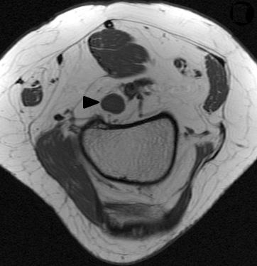 femoral insertion site of medial head of gastrocnemius tendon. Separated from neurovascular bundle in popliteal fossa. 척추마취하에복와위로수술을시행하였고주변조직과잘구분되는피막으로둘러싸인종양을확인하였다. 종양은슬와동맥바로내측심부에위치하였고피막과함께조심스럽게적출하였다.