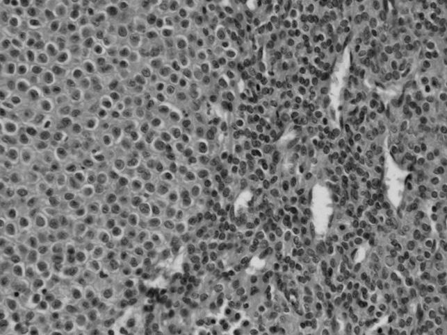 282 Hee-Gon Park, et al. Figure 6. Microscopic findings. () Regular round tumor cells forming solid sheets showed central nuclei, small nucleoli, and conspicuous cytoplasmic borders (H&E, 400).