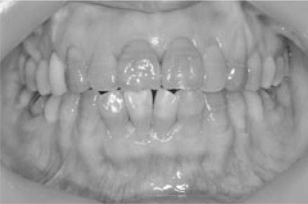 300 Esthetic Rehabilitation of Anterior Dentition by All Ceramic Crowns Using IPS e.max CAD... 나의구조물로이루어진심미보철물을제작할수있는이례적인재료로서심미성면에서매우뛰어난장점이있다. 1990 년도에소개되었던 IPS Empress (Ivoclar Vivadent Ltd.