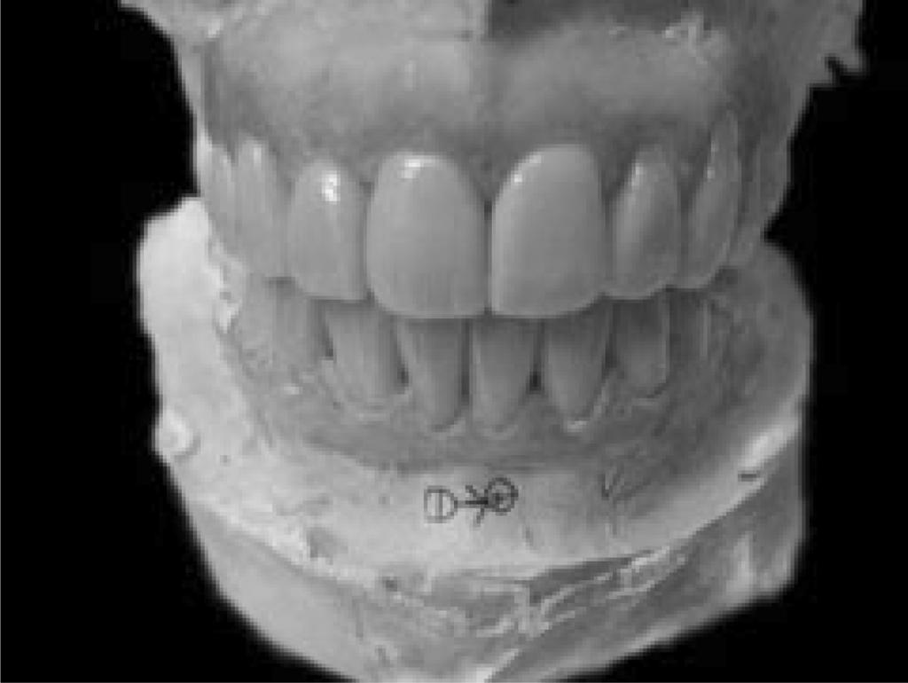 302 Esthetic Rehabilitation of Anterior Dentition by All Ceramic Crowns Using IPS e.max CAD... 테크닉은소프트웨어내에서제안된치아디자인을토대로보철물의외형을제작하는방법이다 13).