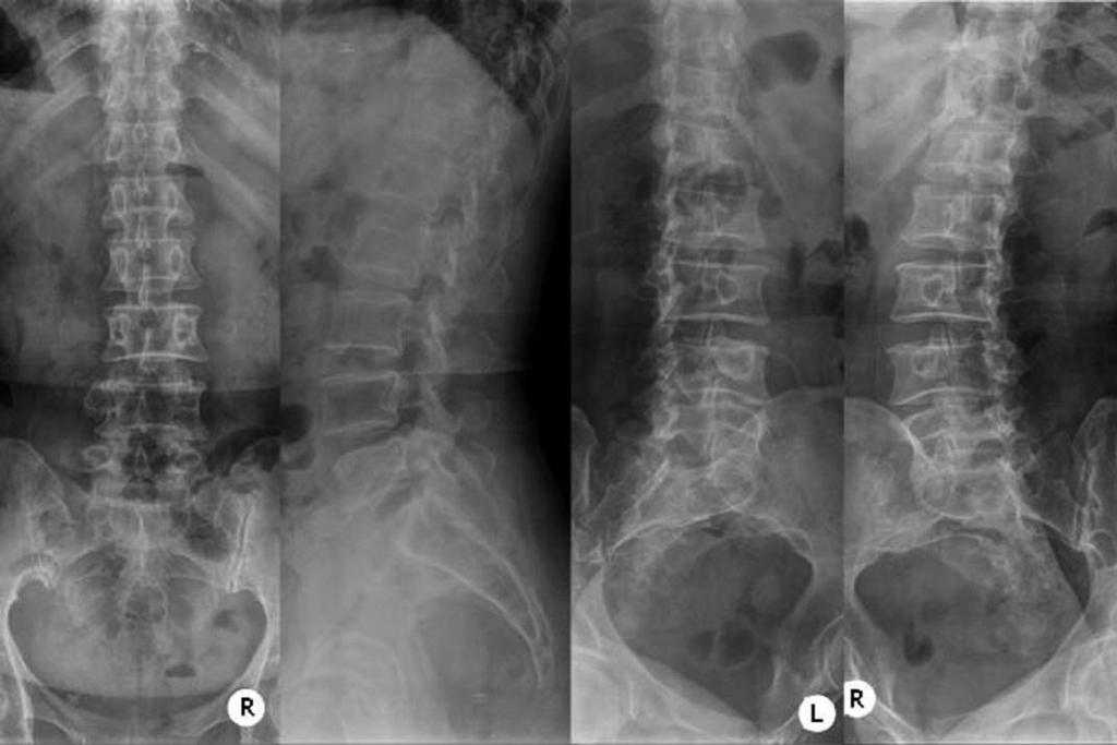 척추경단열의수술적유합 김진수외 Fig. 1. Plain radiographs show that olisthesis of 4 th lumbar vertebra, hypertrophy of the left 4 th lumbar pedicle and contralateral spondylolysis. Fig. 2.