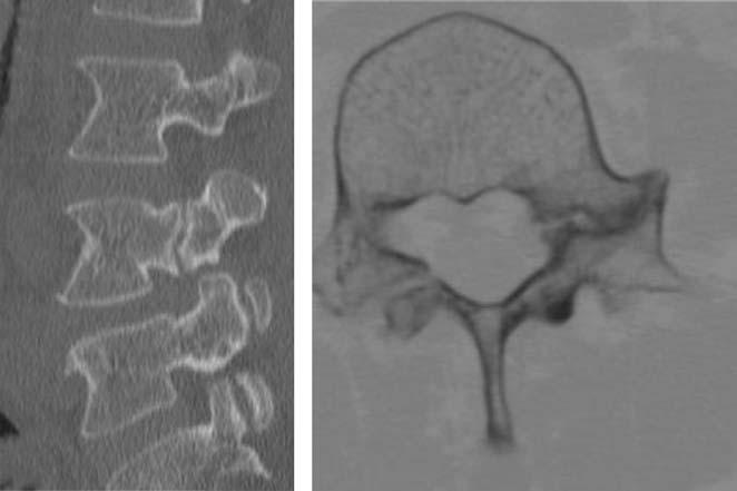 (B) Axial CT image shows radiolucent gap in left pedicle with hypertrophic and sclerotic change and the lytic defect in right pars interarticularis. 발생한요통과좌측하지로의방사통을주소로내원하였다.