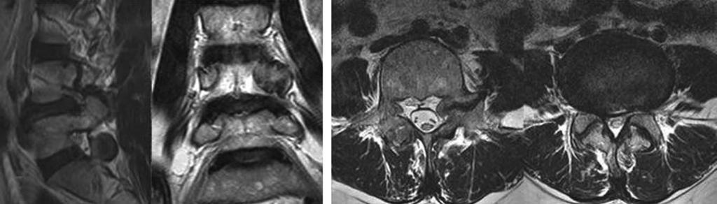 대한척추외과학회지 Vol. 15, No. 2, 2008 Fig. 3. MR findings of pedicular cleft. (A) Sagittal, coronal MR images show the cleft and hypertrophy of the left 4th lumbar pedicle.
