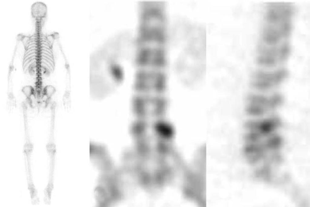 h lumbar nerve root on left foramen by disc bulging and central, lateral recess stenosis by hypertrophied facet joint and disc degeneration. Fig. 4.