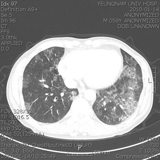 - 폐포단백증 1 예 - Fig. 4. Initial chest CT (09.05.12)of the subject.