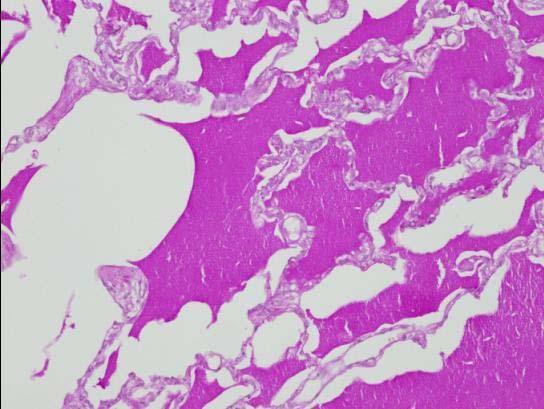 6), 조직학적검사에서는폐포내에지방조직과단백질이침착된전형적인폐포단백증의소견을보였고 (Fig.