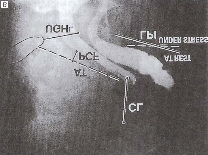 complex; V, Vagina B: Standing view of lateral radiograph.
