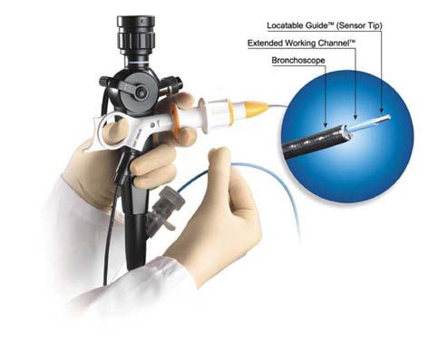 - Seok-Chul Yang: Updates in diagnostic bronchoscopy for lung cancer - Figure 4. The steerable probe with bronchoscope. Reprinted with permission 43). Figure 5.