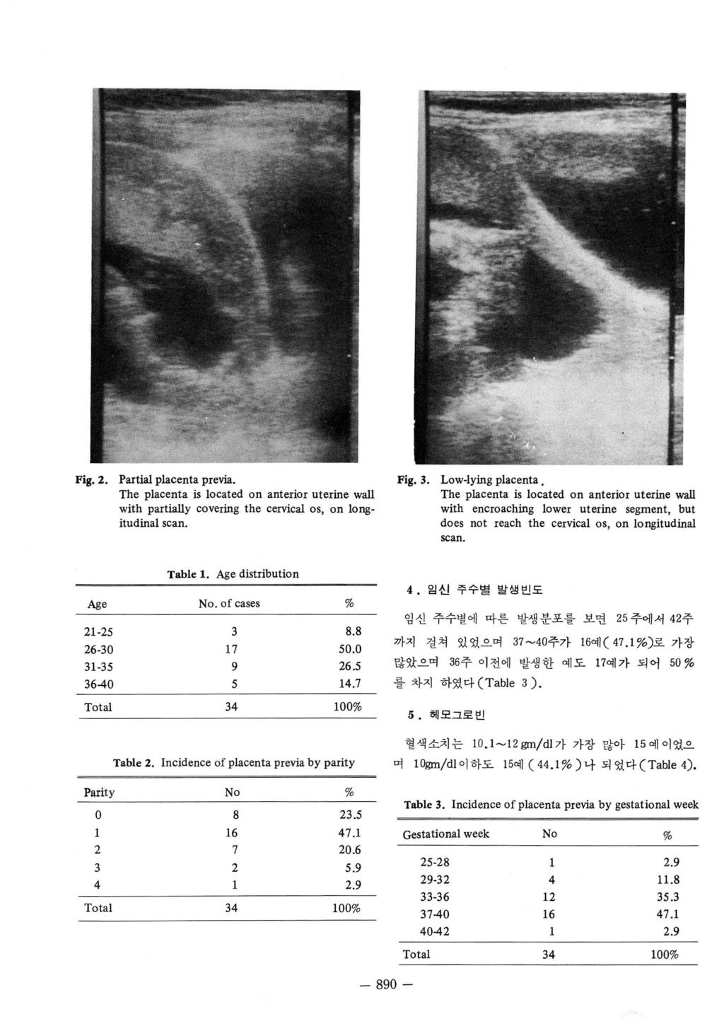 Fig. 2. Partial placenta pre 꺼 a. The placenta is located on anterior uterine wa1l with partia1ly covering the cervica1 os, on longitudinal scan. Fig.3. Low-lying placenta.