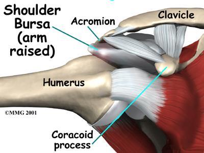 Subacromial bursitis & Subdeltoid bursitis