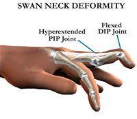 Boutonniere deformity Gamekeeper thumb (ulnar