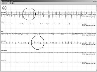 Free-running electromyography patterns. Fig. 3. Artifact of Free-running electromyography.