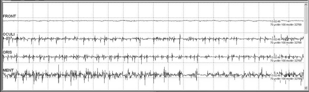 42 Sang-Ku Park. Intraoperative Neurophysiological Monitoring in Cerebello Pontine Angle Tumor Fig. 6. Electromyography of self activity. 첫째, 환자의호흡곡선에자발호흡의조짐이관찰된다. 둘째, 혈압이서서히오른다.