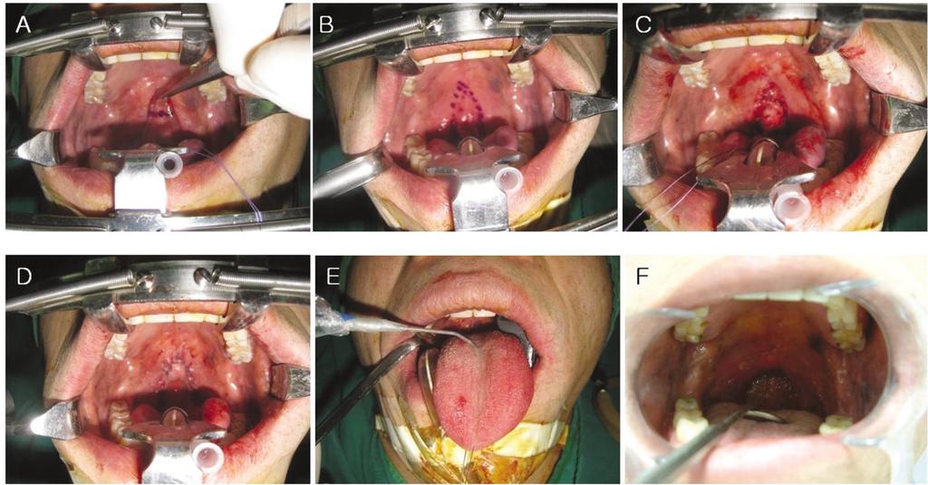 J Korean Assoc Oral Maxillofac Surg 2011;37:81-5 Fig. 3. A procedure of the extended uvulopalatal flap technique. A. The uvular and soft palate is retracted forward. B.