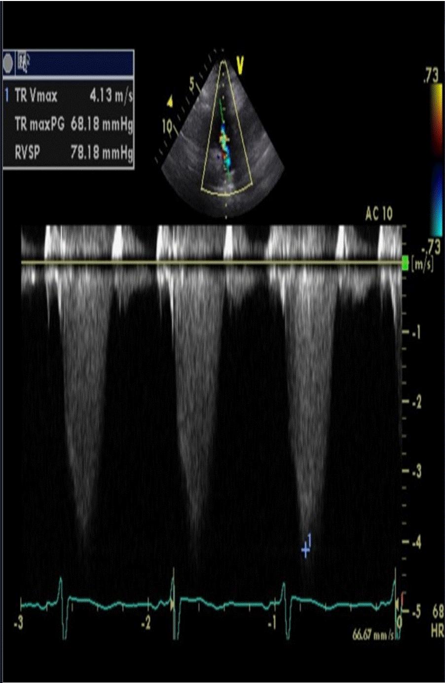 Echocardiography shows increased right ventricular systolic pressure ().