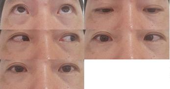 한방안이비인후피부과학회지제 31 권제 4 호 (2018 년 11 월 ) 2018/07/30 2018/08/03 2018/08/07 2018/08/11 2018/08/13 Fig. 7 Progress Note of Eye Movement. Fig. 8 Change of Symptoms Ⅳ.
