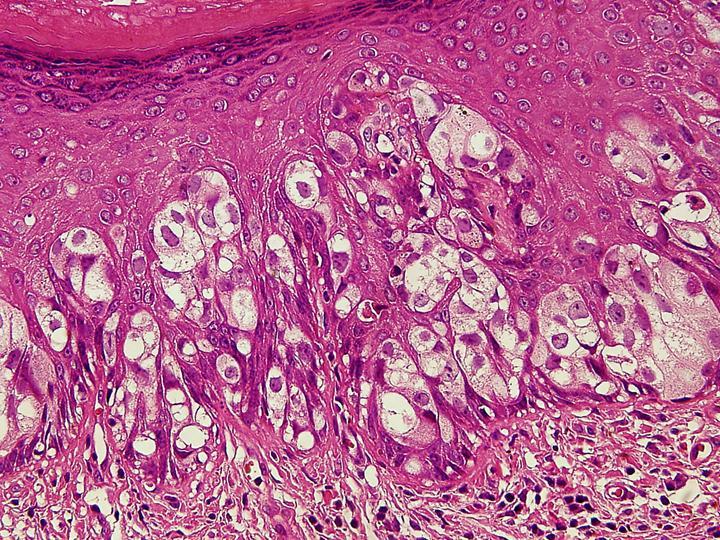 이현철 외 8인. 외음부 파젯씨병 는 환자는 없었다. Fig. 2. Epidermis contains large pale tumor cells that form solid nests, glandular spaces, or continuous layer along the epidermal basement membrane (H&E stain, 400).