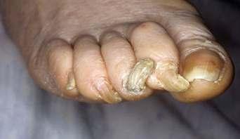 Changes in the toe nails Accelerated by