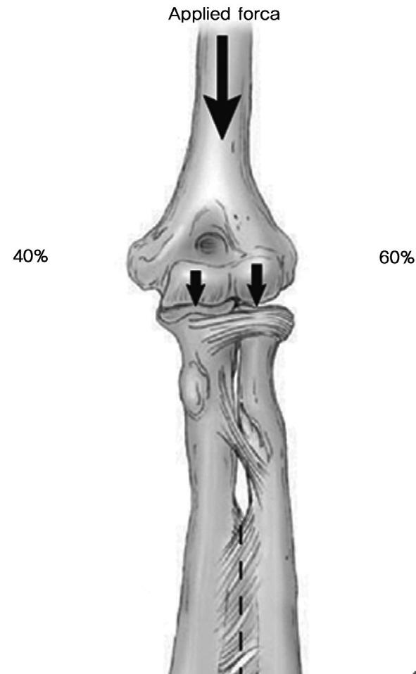 문준규 : 주관절의생역학 III. 안정성 (Stability) 주관절은인체의관절중에서가장관절면이서로일치되어 (congruous) 있는안정된관절이다. 이안정성은골관절면과이를둘러싼연부조직의역할로이루어진다. 골관절면은구상돌기, 주두및요골두가관절의안정성에기여하며, 연부조직은크게전방관절낭과내외관절낭이두꺼워져형성된측부인대복합체로나눈다 1,