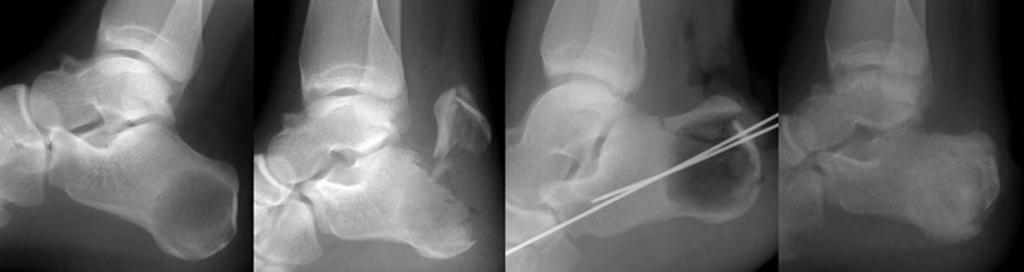 이승환외 : 연골모세포종 - 골단과견인골단의비교 - A B C D Fig. 5. A 15-year-old man with left heel pain. (A) Preoperative calcaneal lateral view shows chondroblastoma at apophysis of the calcaneus.