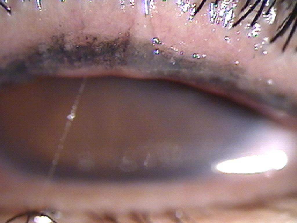 Lid margin injection and telangiectasis were shown
