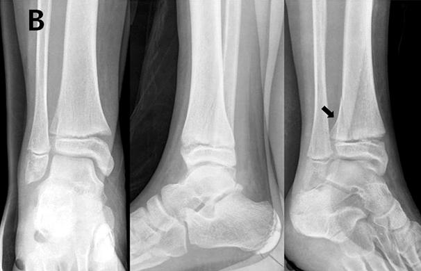 대상 및 방법 2003년 1월부터 2008년 12월까지 족관절부 성장판 손상 으로 치료한 후 1년 이상 추시 가능하였던 예를 대상으 로 하였으며 성장이 끝나가는 이행기 골절인 연소기 Fig. 1. A 7 year-old boy sustained physeal injury of the ankle.