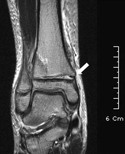 (B) Post-reduction radiographs demonstrate satisfactory closed reduction. Distal tibia fracture has Thurston-Holland fragment (arrow), it representing Salter-Harris type II injury.