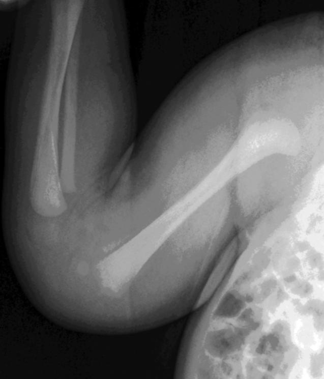 Radiographs of both femurs at 5 days after delivery show a Salter-Harris type 1 fracture of the right distal femoral epiphysis.