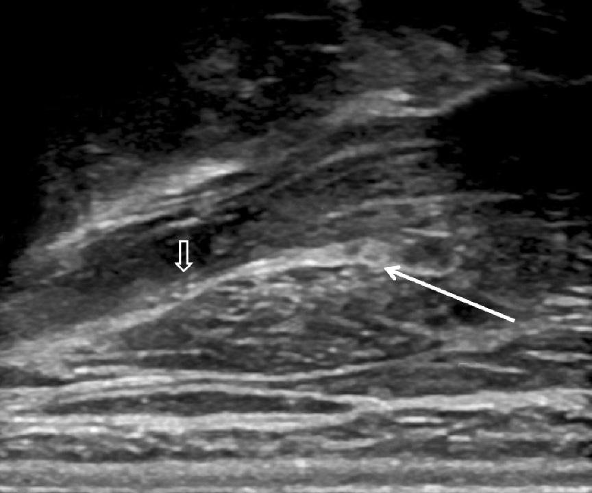 () Ultrasound probe is placed in transverse plane at the level of the medial superior nuchal line.