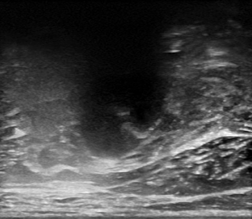 89 Ultrasound-Guided Intervention in ervical Spine 7 R Figure 25. () Transverse scan at the base of neck. Transverse process of 7 and 1st rib (R) joins like a joint.
